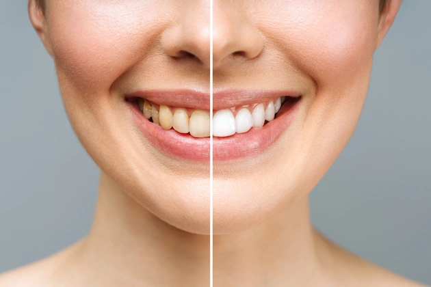 How To Whiten Yellow Teeth