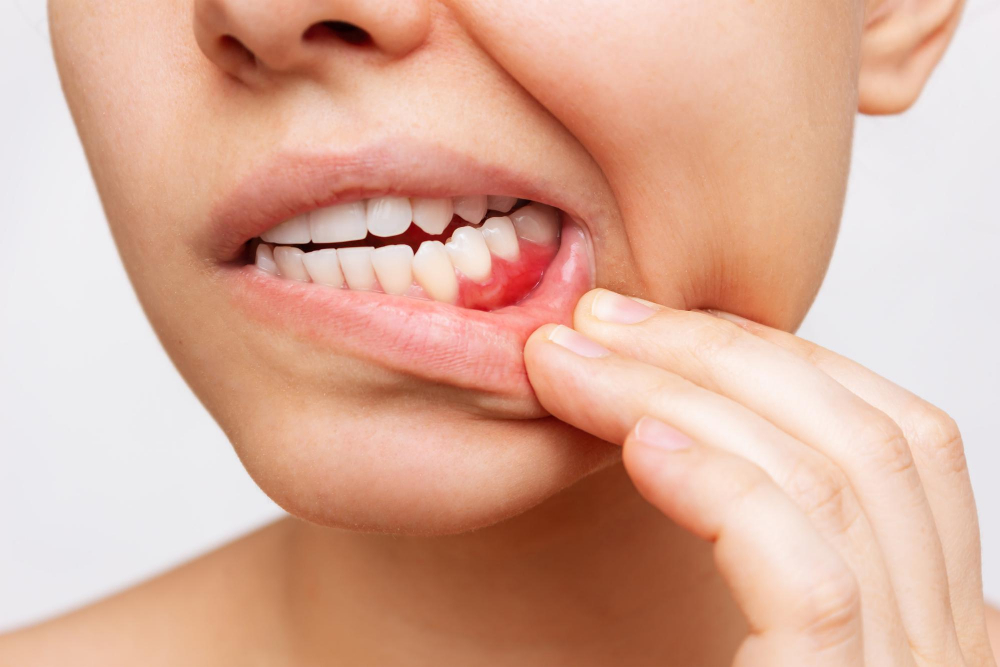 Gum Inflammation: Causes And Remedies