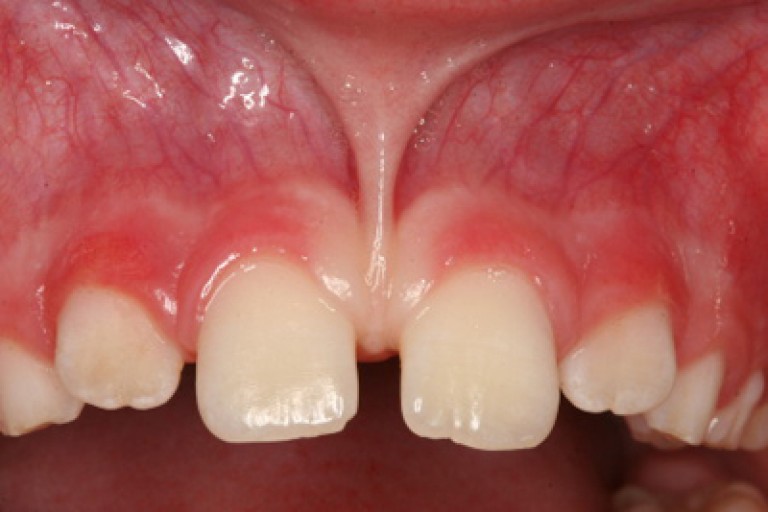 All About The Frenulum In The Mouth