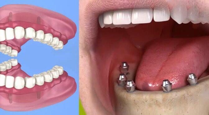 full-mouth-dental-implants-turkey-antalya1-672×372