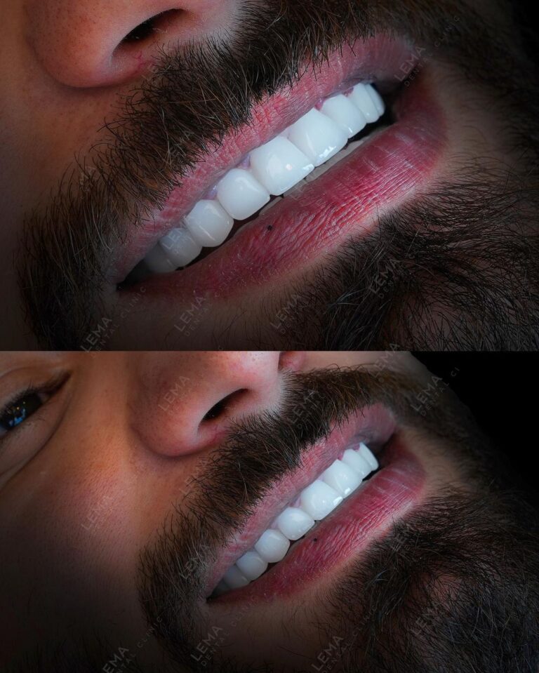 hollywood smile1