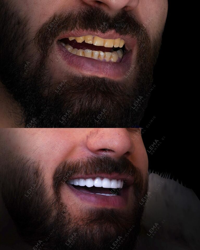 hollywood smile2