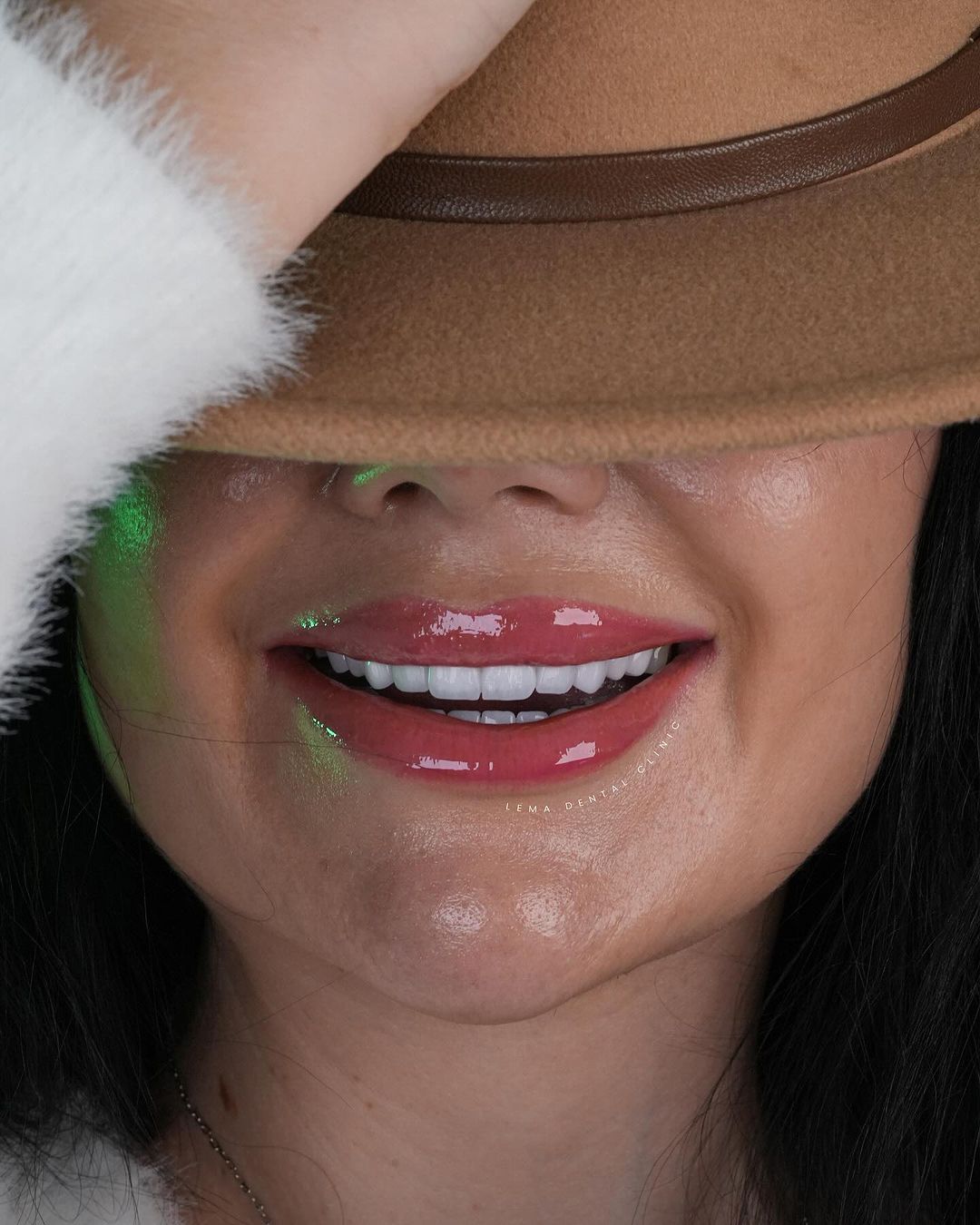 hollywood smile3
