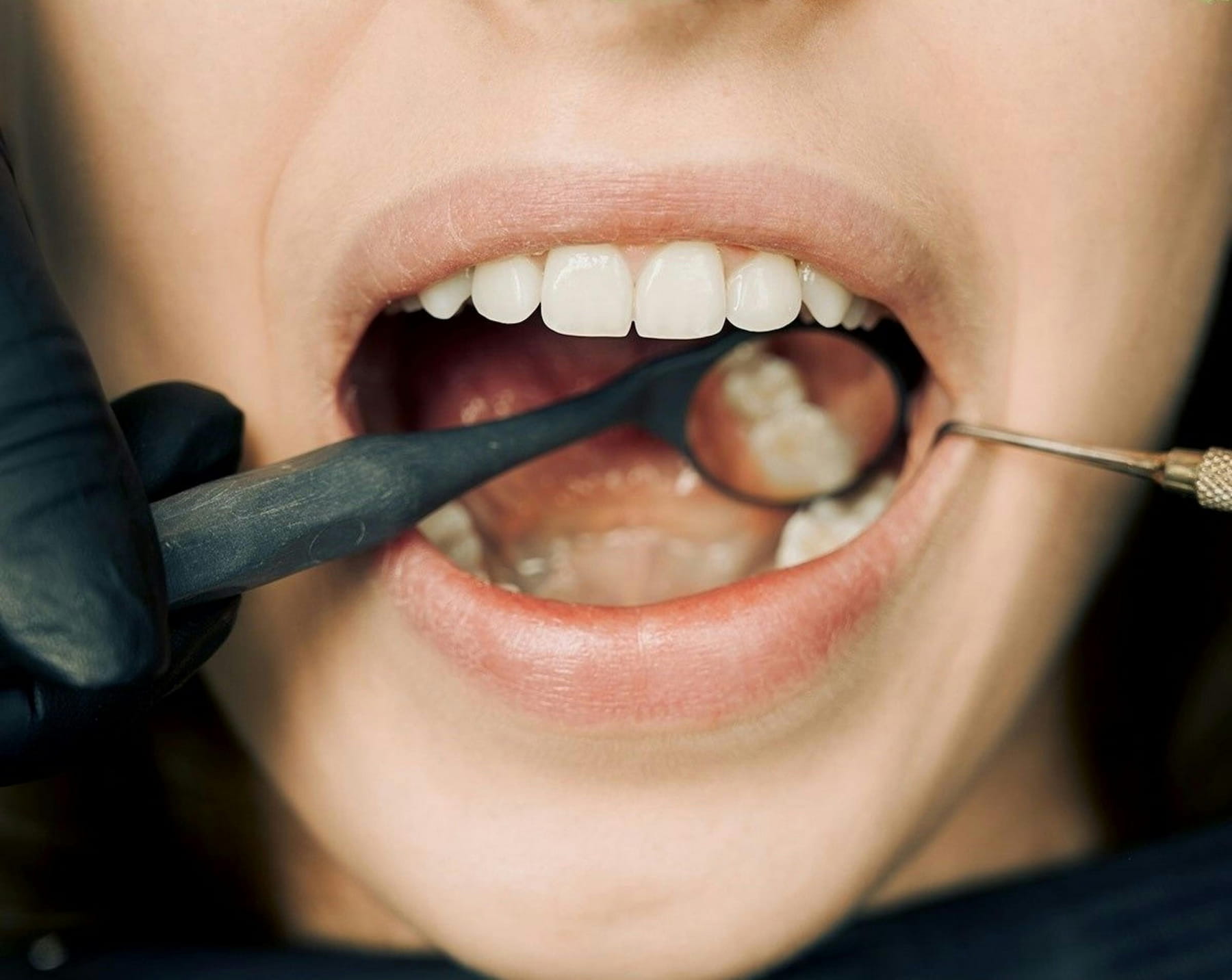 how-long-do-dental-implants-take