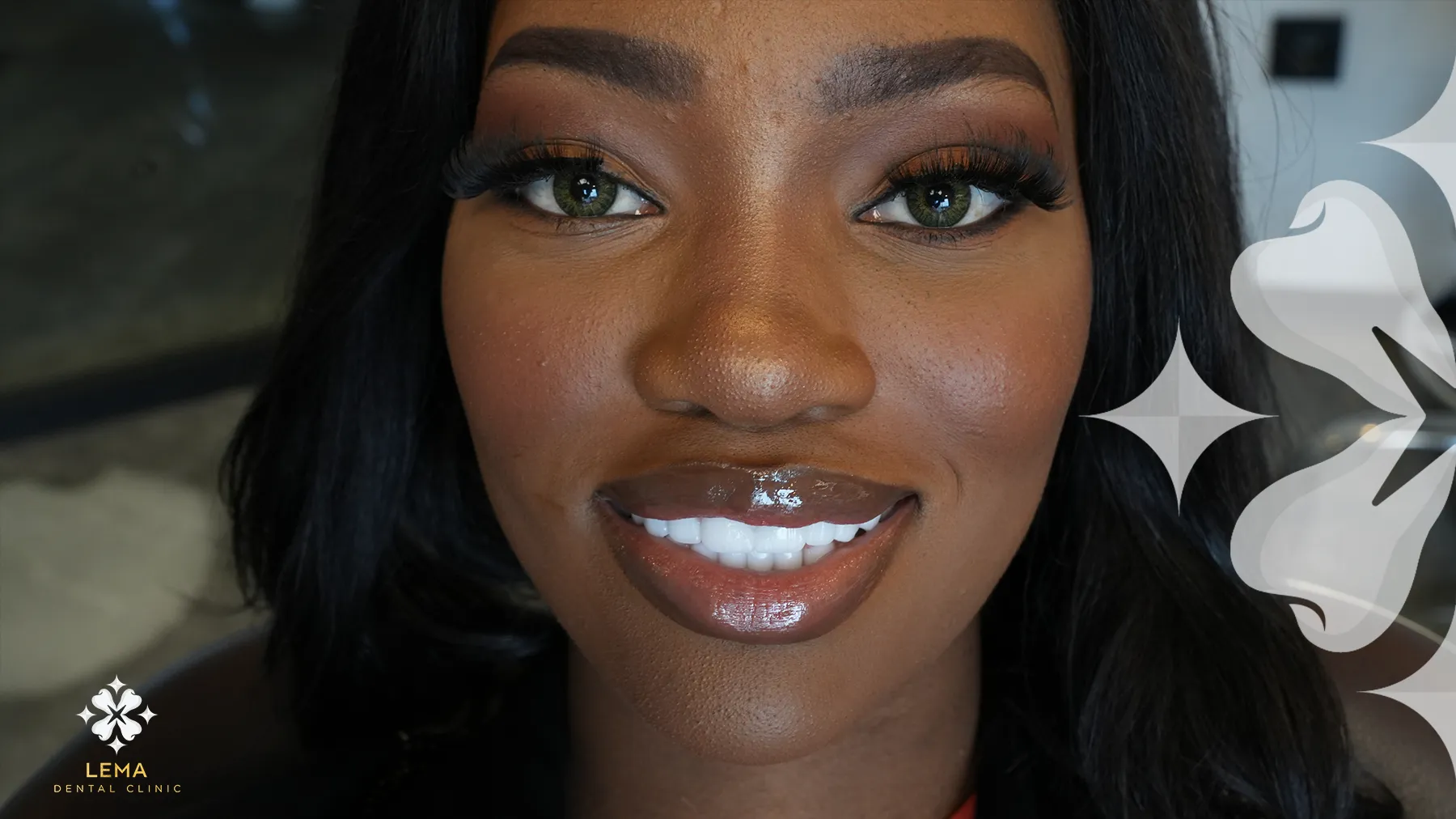 il sorriso di hollywood ha effetto sui denti naturali