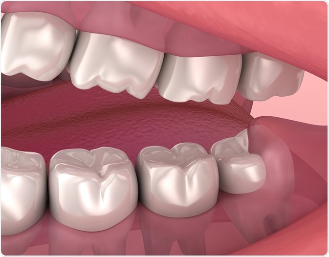 How Many Molars Do We Have?