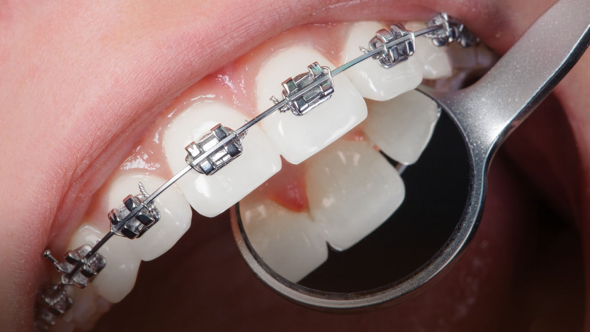 aparat dentar