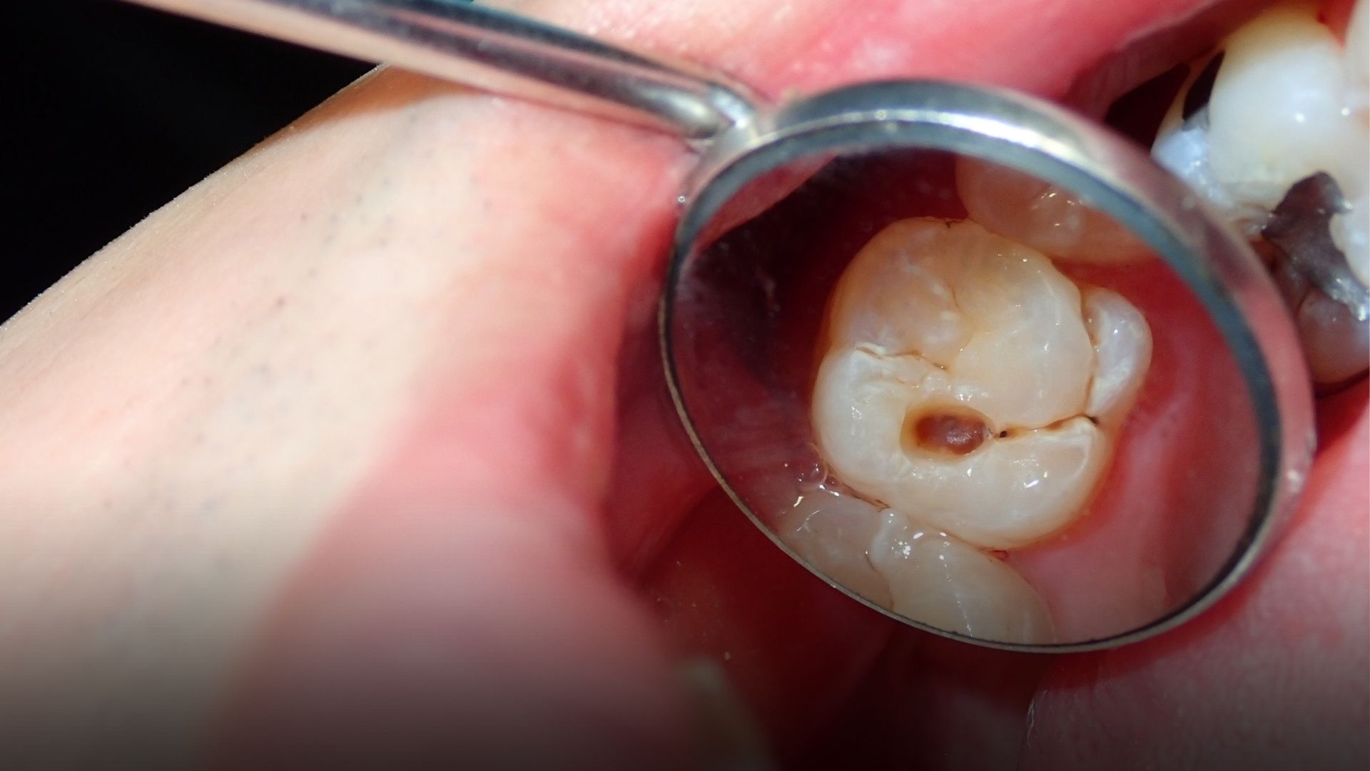 caries treatment without drilling