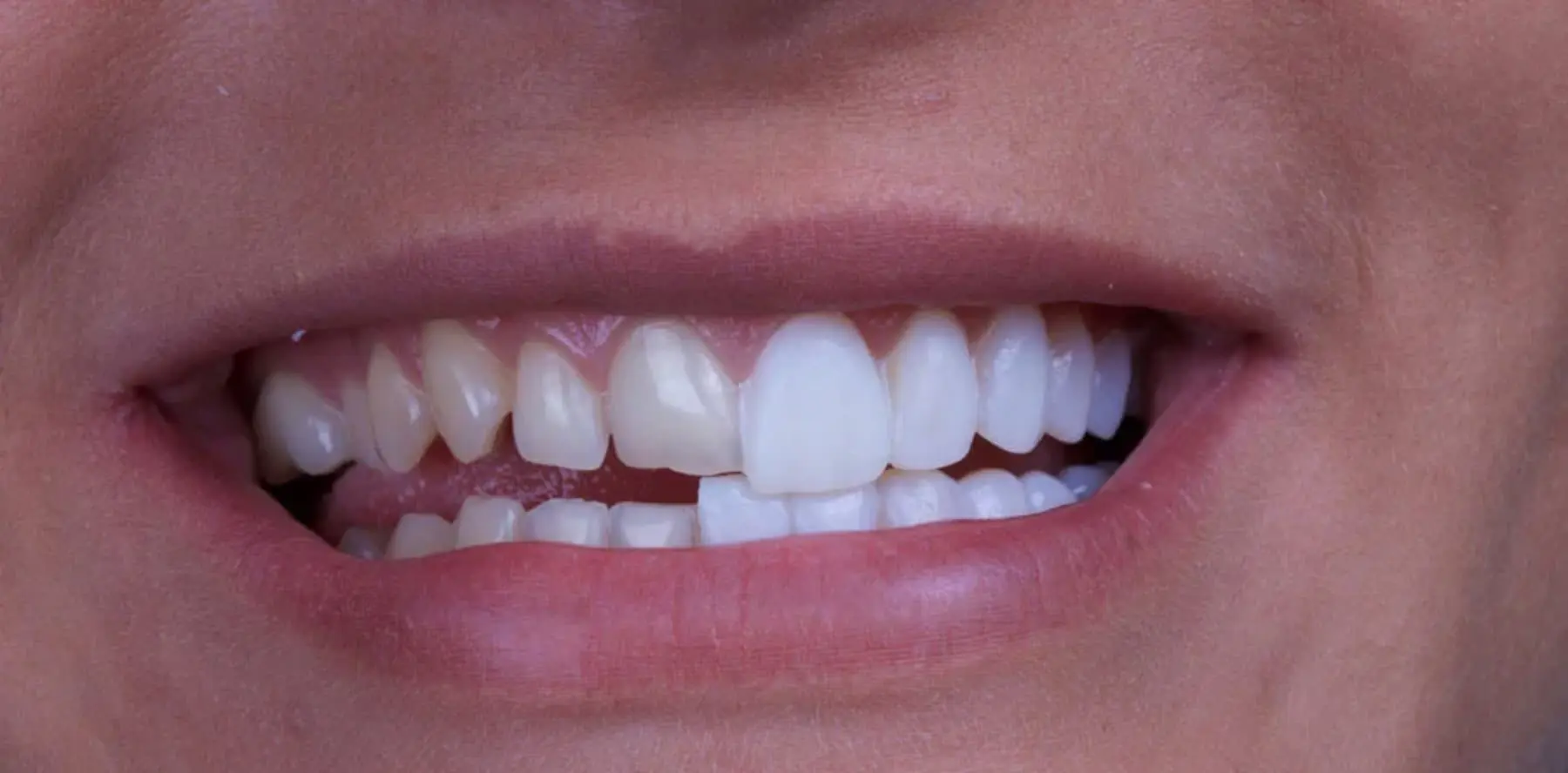 Cost Of Teeth Veneers: What You Need To Know