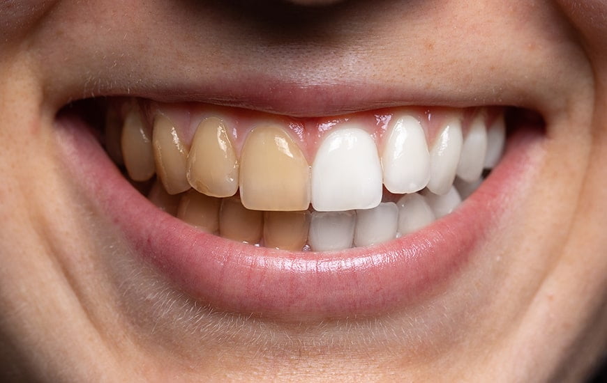 Porcelain Veneers: Cost And Benefits