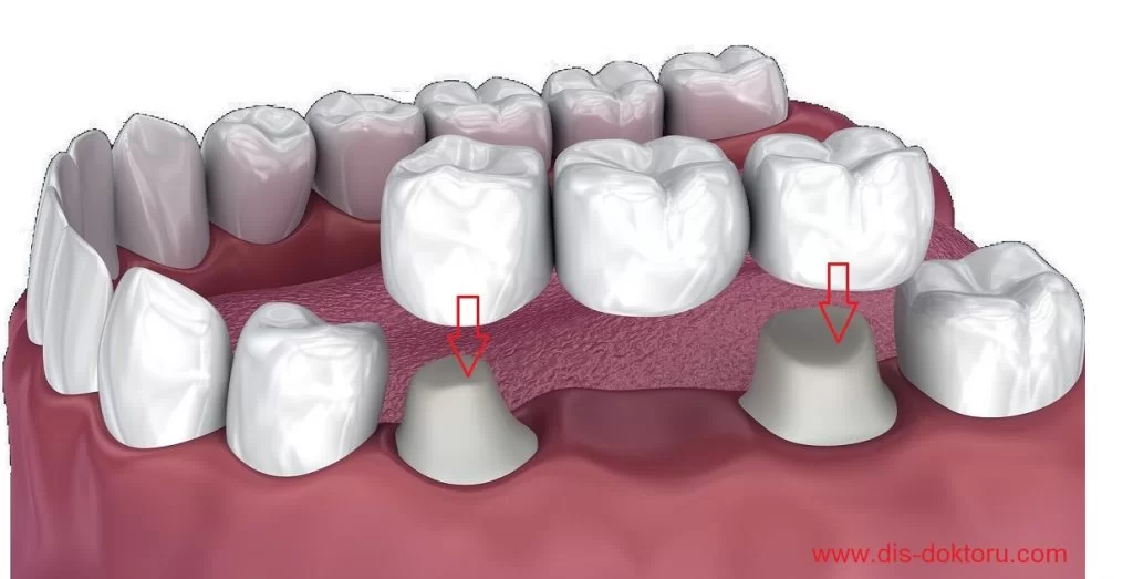 What Is A Dental Bridge And Its Benefits?