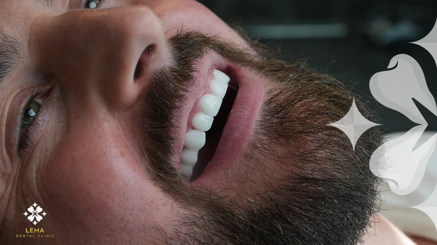 implant dentar