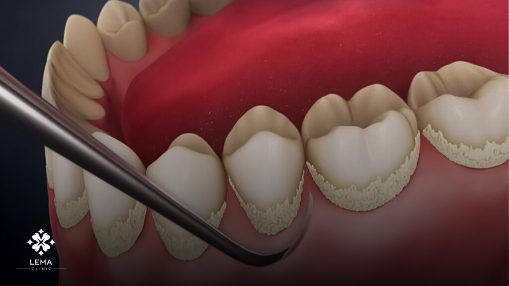 Understanding Dental Tartar And Its Effects
