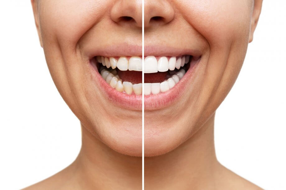 Dental Veneers Satisfaction Survey