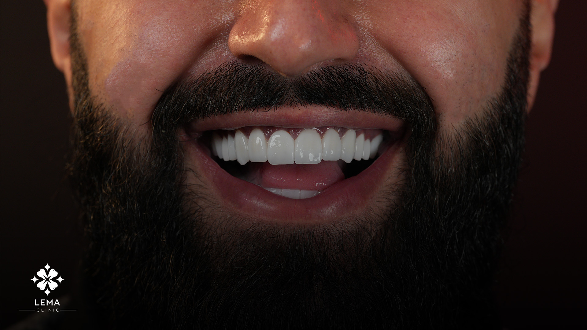 veneers kosten türkei