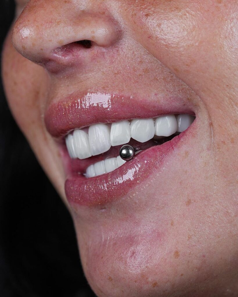 veneers type