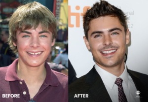 Зубы Zac Efron раньше