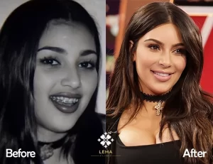 Зъбите на Kim Kardashian преди